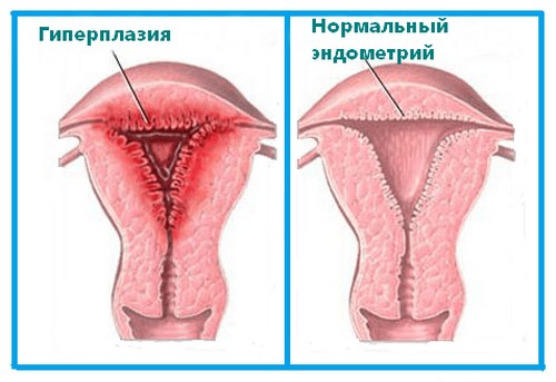 гиперплазия эндометрия матки
