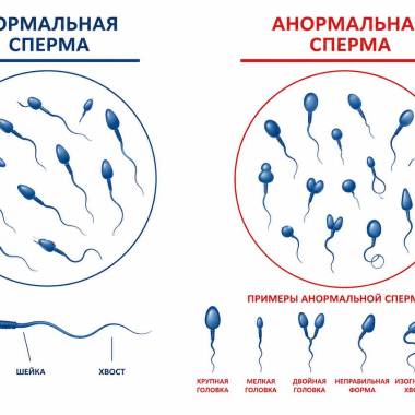 Тератозооспермия у мужчин