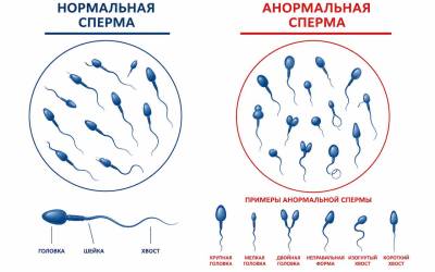 Тератозооспермия у мужчин