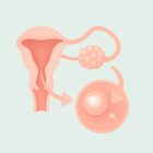 ЭКО при поликистозе яичников