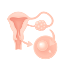 ЭКО при поликистозе яичников