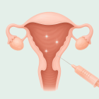ЭКО в естественном цикле