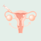 ЭКО в стимулированном цикле