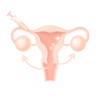 ЭКО в стимулированном цикле